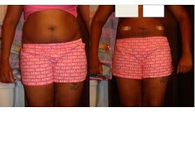 Smart Lipo | a black girls story Smart Lipo, Tooth Pulled, Wisdom Tooth, Post Op, Wisdom Teeth, Baby Grow, Best Practices, I Got This, Casual Shorts