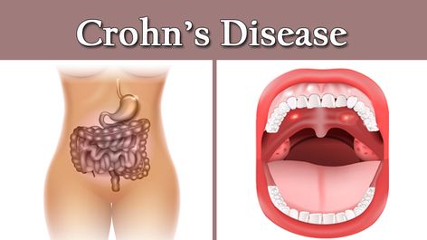 Signs of Crohn's Disease Every Woman Should Know About - WomenWorking Crohns Symptoms Signs, Chrons Disease Symptoms Crohns, Chrones Disease Symptoms, Chrons Disease Symptoms, Chrons Diet, Chrones Disease, Uc Diet, Crohns Symptoms, Crohns Diet