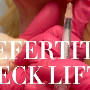 Dr. Kay Durairaj, MD, FACS on Instagram: "Have you heard of a Nefertiti Neck Lift? 🧐 Botox here improves the drape the skin and the jawline contour and provides the visual effect of a ‘mini lift’. The ‘Nefertiti lift’ is a minimally invasive, effective and acceptable alternative for those patients seeking an effective way to sharpen the beautiful neck. The neck bands you see in this video are called platysmal bands. These bands are vertical neck muscles that become more prominent with age. Whil Nefertiti Neck Lift, Platysmal Bands, Jawline Contour, Facial Injections, Chin Filler, Neck Muscles, Cheek Fillers, Beautiful Neck, Facial Aesthetics