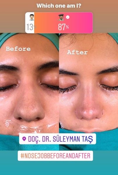 Thick Skin Bulbous Tip Rhinoplasty | Assoc. Prof. Dr. Suleyman TAS