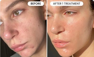 Epidermal Growth Factor, Post Acne Marks, Best Serum, Fade Dark Spots, Acne Marks, Skin Concern, Skin Cream, Dull Skin, Facial Skin Care