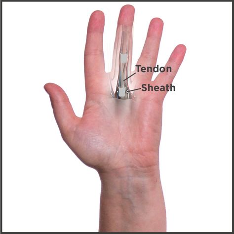 Trigger Finger | Stenosing Tenosynovitis Surgery, Remedies & Therapy Trigger Finger Exercises, Hand Therapy Exercises, Nerve Pain Remedies, Joints Pain Remedy, Tens Machine, Hand Health, Finger Exercises, Nerve Health, Trigger Finger