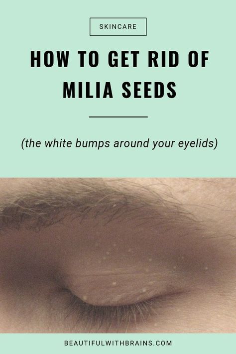 White Bump On Eyelid, White Pimples On Face, White Bumps On Face, Pimple On Eyelid, Hard Pimple, Bumps Under Eyes, Small Pimples, Blind Pimple, Pimples Under The Skin