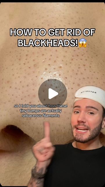 Black Head Remedies, Easy Ways To Get Rid Of Blackheads, Skincare Routine For Blackheads, Best Way To Get Rid Of Blackheads, How To Get Rid Of Pimples And Blackheads, How To Get Ride Of Black Heads On Nose, How To Extract Blackheads, Dry Forehead Remedies, How To Clear Blackheads On Nose