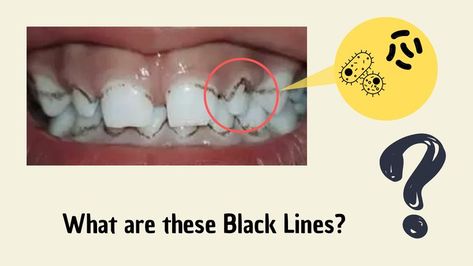 Black lines on teeth Teeth Tartar Removal, Tartar Teeth, Tartar Removal, Black Teeth, Country Studies, Stained Teeth, Diy Backdrop, Black Lines, Black Line