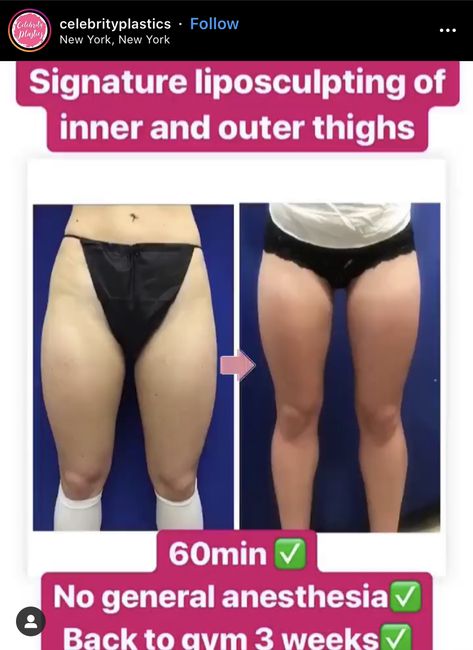 lipo on legs Thigh Lipo Before And After, Lipo Before And After, Laser Lipo, Fitness Goals, Beauty