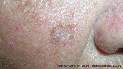 Squamous Cell Carcinoma Basil Cell Carcinoma, Cancerous Moles, Diseases Pictures, Skin Anatomy, Abnormal Cells, Basal Cell, Squamous Cell, Skin Growths, Types Of Skin