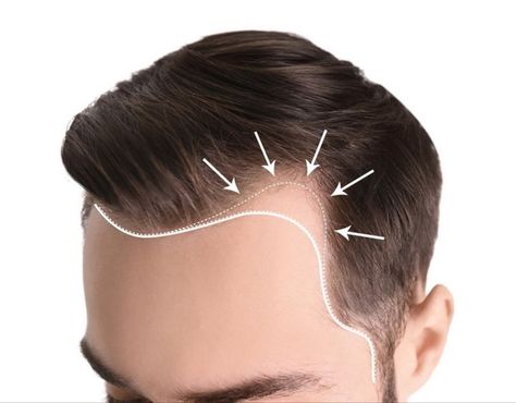 Bad Hairline, Eyebrow Hair Transplant, Causes Of Hair Fall, Excessive Hair Fall, Hair Fall Problem, Hair Transplant Cost, Hair Transplant Procedure, Fue Hair Transplant, Hair Transplant Surgery