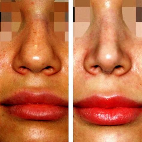 Bulbous Nose Rhinoplasty, Nose Rhinoplasty, Nose Plastic Surgery, Nose Surgery Rhinoplasty, Nose Tip, Bulbous Nose, Nose Jobs, Rhinoplasty Nose Jobs, Rhinoplasty Before And After