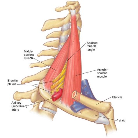 scalene muscles enclose the brachial plexus (image) Thoracic Outlet, Subclavian Artery, Radial Nerve, Vertebral Artery, First Rib, Peripheral Nerve, Trigger Point Therapy, Trigger Points, Fitness Advice