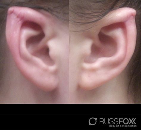 Subtle points - Healed Slightly Pointed Ears, Ear Pointing, Goblin Ears, Character Customization, Darwin Awards, Mod Jewelry, Pointed Ears, Elf Ears, Anatomy For Artists