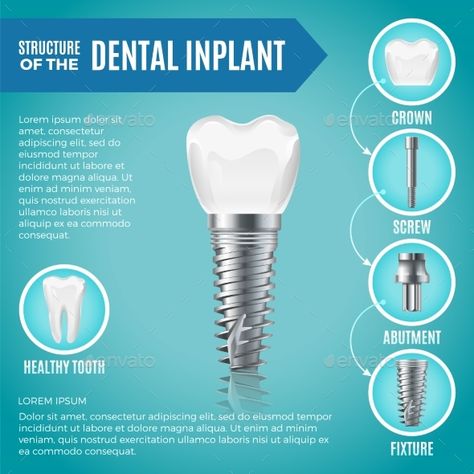 Teeth maquette. Structural elements of dental implant. Infographic for medicine poster. Vector dental poster, implant medical tooth illustration Medicine Poster, Dental Poster, Herbal Toothpaste, Best Dental Implants, Remedies For Tooth Ache, Dental Posters, Teeth Implants, Dental Bridge, Family Dental