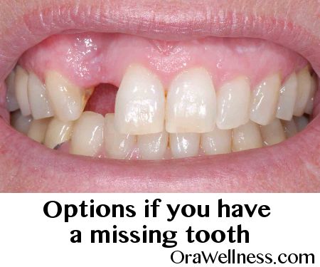 If you are missing teeth or even a single missing tooth, you have several options to restore your precious smile. FREE guidebook here. Natural Teeth Whitening Remedies, Fix Teeth, Chipped Tooth, Temporary Tooth, Missing Tooth, Tooth Repair, Teeth Whitening Remedies, Teeth Whitening Diy, Loose Tooth