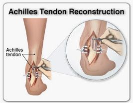 Achilles Surgery Recovery Tips, Achilles Tendon Ruptures, Achilles Pain, Ankle Surgery, Achilles Tendon, Surgery Recovery, Medical Terms, Calf Muscles, Post Surgery