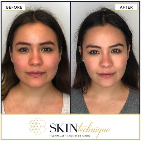 Massater Before And After, Face Procedures, Jaw Reduction Surgery, Face Fillers, Beauty Procedures, Botox Face, Face Surgery, Facial Surgery, Anti Wrinkle Treatments