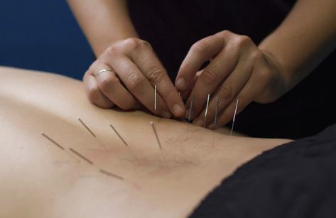 Needling Therapy, Dry Needling Therapy, Nerve Problems, Remedial Massage, Acupuncture Clinic, Ligament Tear, Dry Needling, Physiotherapy Clinic, Muscular System