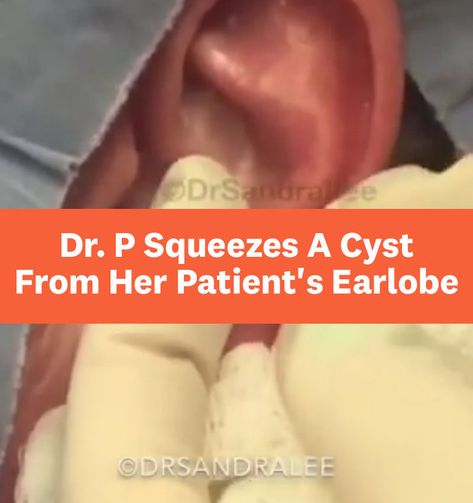 In Dr. Pimple Popper's gnarly new Instagram video, she helps a patient with a huge cyst growing on the earlobe. Ear Cysts Popping, Body Acne Products, Cysts Popping Videos, Get Rid Of Body Acne, Zit Popping Video Faces, Huge Blackheads, Big Zits, Head Pimples, Huge Pimple