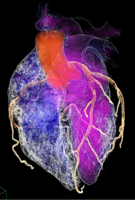 cardiac CT.  Cool pic The Human Heart, Cardiac Nursing, Surgical Tech, Medical Art, Anatomical Heart, Cardiovascular System, Human Heart, Cardiology, Medical Science