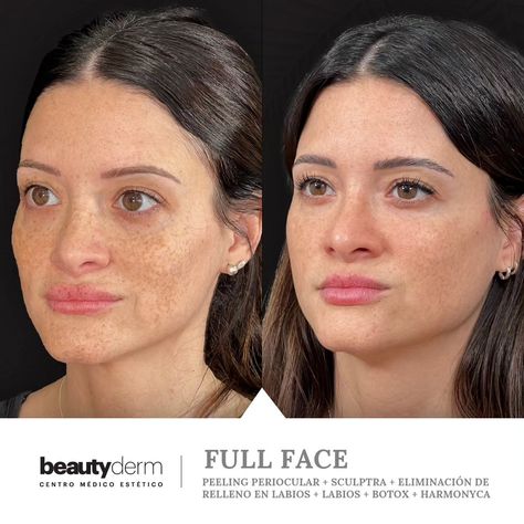 Antes y despu�és de Soledad ⏩ En este caso le realizamos FULL FACE: Peeling periocular + Sculptra + Eliminación de relleno en labios + Labios + Botox + HArmonyCA ✔️ El tratamiento es indoloro y seguro. ¿Querés comenzar? Pedí un turno 📲 11 5494 3993 #aumentodelabios #rellenodelabios #rostroiluminado #volumenenlabios #hidrataciondelabios #medicinaestetica #esteticaargentina Face Peeling, Full Face, Facial, Photoshop