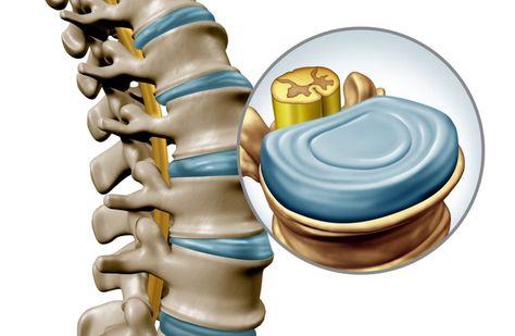 Cauda Equina, Intervertebral Disc, Spinal Fusion, Spinal Column, Human Spine, Disk Herniation, Cervical Vertebrae, Spinal Nerve, Peripheral Nerve