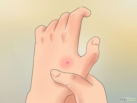 How to Treat Spider Bites via wikiHow.com Spider Bites Remedies, Treating Spider Bites, Spider Bite Symptoms, Spider Bites Pictures, Spider Identification, Dangerous Spiders, Home Remedies For Spiders, Spider Bite, Spider Pictures