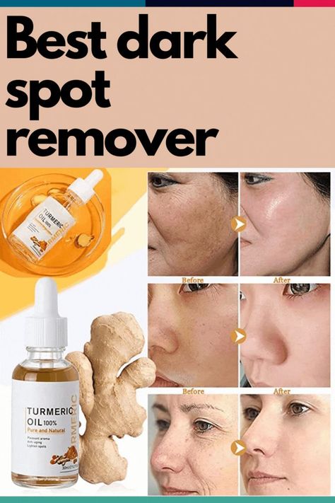 Best Dark Spot Remover, Dark Spot Remover For Face, Dark Spot Remover, Natural Face Care, Turmeric Oil, Acne Dark Spots, Spot Remover, Brown Spots Removal, Dark Spot Corrector