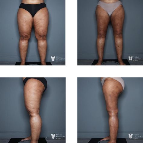 Lipedema Before And After, Lipedema Fashion, Reduction Surgery, Breast Health, Health Coaching, Diet Supplements, Health Coach, Newest Trends, Surgery