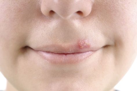 Preventing cold sores - Harvard Health Fever Blister Causes, Fever Blister Remedy, Home Remedies For Fever, Cold Sore Prevention, Nose Pimples, Lips Care, Fever Blister, Canker Sore, Cold Sores Remedies