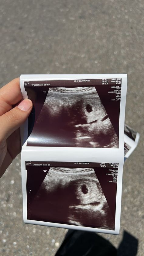 7 Weeks Pregnant Ultrasound, Ultrasound Prank, 3rd Month Pregnancy, Fake Ultrasound, Baby Ultrasound Pictures, Pregnancy Scan, 7 Weeks Pregnant, Twin Baby Photos, Fake Pregnancy