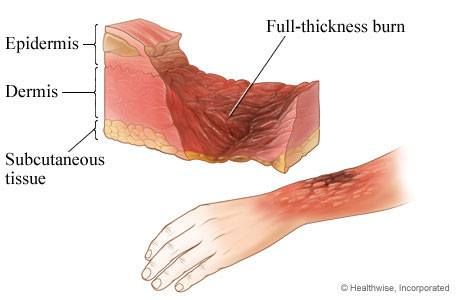 Burns - All you ever wanted to know: 3rd-degree burn  The most serious burns involve all layers of the skin and cause permanent tissue damage. Fat, muscle and even bone may be affected. Areas may be charred black or appear dry and white. Difficulty inhaling   https://www.facebook.com/Bhealthy1 https://www.jmwellness.in http://impact-myhealth.blogspot.in/ https://www.facebook.com/video.php?v=741975545892397&video_source=pages_finch_main_video 3rd Degree Burns, Degree Burns, Subcutaneous Tissue, Health Supplements, Fatty Acids, Muscles, Anatomy, Medical, Skin