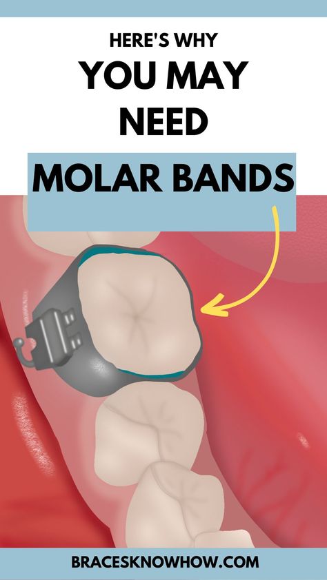 Not all patients get molar bands with braces, but sometimes they really help. Learn about spacers, band fitting appointments, and all you need to know about molar bands! Spacers For Braces, Braces Bands, Types Of Braces, Orthodontic Appliances, Braces Colors, Dental Crowns, Cosmetic Dentistry, Cavities, Braces