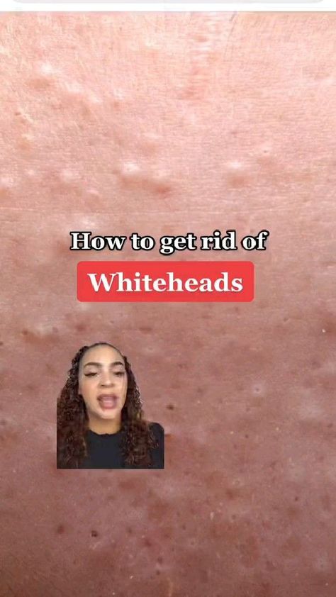 how to get rid of white heads fast White Heads On Nose, White Pimples On Face, Oily Nose, Head Pimples, Head Acne, Get Rid Of Spots, Get Rid Of Pores, Pimples On Forehead, Forehead Acne