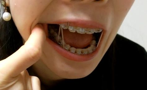 #braces #braceface #metalbraces #girlswithbraces #elastics #loops Grey Braces, Braces Aesthetic, Teeth Aesthetic, Brace Face, Metal Braces, Braces, Elastic, Grey, Hair