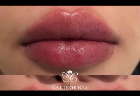 Big And Plump Lips, Plump Lips Naturally Aesthetic, Asian Lip Filler, Big Upper Lip, Small Nose Big Lips, Full Lips Aesthetic, Big Plump Lips, Plump Lips Aesthetic, Big Lips Aesthetic