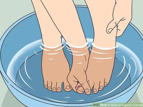 Diy Salt Bath, Ingrown Toenail Remedies, Epsom Salt Foot Soak, Infected Toenail, Toenail Removal, Nail Remedies, Epson Salt, Family Nutrition, Ingrown Toenail