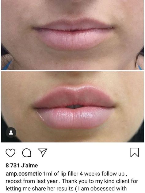 1 ml of lip filler 4 weeks follow up Different Styles Of Lip Filler, Hollywood Lips Filler, Lip Filler Shape Ideas Pouty, Lip Filler Shape Ideas 1ml, Lip Fillers Before And After 1ml Russian, Keyhole Pout Lips, Lip Filler 1 Syringe, Lips Before And After Injections, Lip Injections Shapes