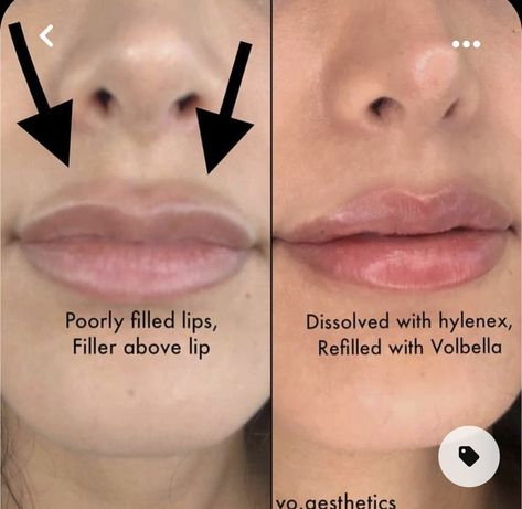 Lip Fillers Juvederm, Dermal Fillers Lips, Lips Inspiration, Face Fillers, Botox Lips, Hyaluronic Acid Fillers, Facial Fillers, Cosmetic Injectables, Lip Augmentation