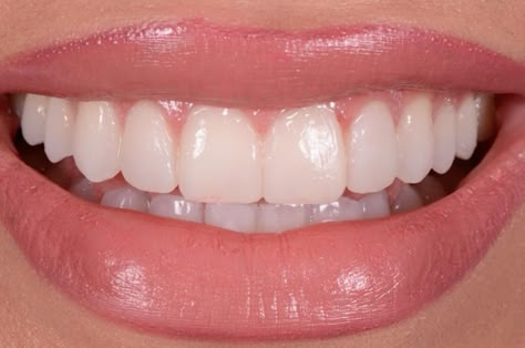 Pretty Teeth Aesthetic, Perfect Smile Aesthetic, Pretty Smile Aesthetic, Dream Teeth, Perfect Teeth Smile, Teeth Aesthetic, Pretty Teeth, Veneers Teeth, Beautiful Teeth