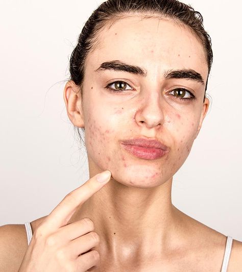 Acne Vulgaris, Natural Acne Remedies, Types Of Acne, Hormonal Acne, Cystic Acne, Acne Remedies, Skin Cleanser Products, How To Treat Acne, Facial