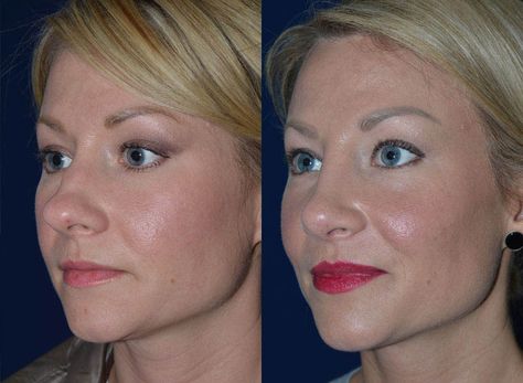 Rhinoplasty Bulbous Tip, Bulbous Tip Rhinoplasty, Bulbous Nose Rhinoplasty Before After, Bulbous Nose Rhinoplasty, Tip Rhinoplasty, Nose Rhinoplasty, Nose Plastic Surgery, Rhinoplasty Recovery, Lipo Before And After