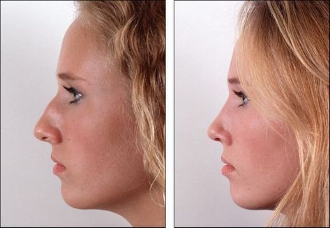 Jaw Reduction Surgery, Nose Plastic Surgery, Nose Surgery Rhinoplasty, Lipo Before And After, Plastic Surgery Fail, Nose Jobs, Rhinoplasty Nose Jobs, Rhinoplasty Before And After, Plastic Surgery Gone Wrong