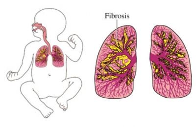 What is BPD? - Bronchopulmonary dysplasia (BPD) is a chronic lung disease that mainly affects infants born prematurely. It causes scarring or fibrosis in their lungs. Your baby may have this condition if:  They had immature lungs. They received high concentrations of oxygen for long periods of time. They were put on a ventilator—a breathing machine—for an extended time period. Or if they had lung infections or pneumonia. Pulmonary Stenosis, Pediatric Respiratory Disorders Nursing, Lung Exercises For Pneumonia, Interstitial Lung Disease, Diagram Of Lungs Respiratory System, Bronchopulmonary Dysplasia, Peds Nursing, Restrictive Lung Disease, Chronic Lung Disease