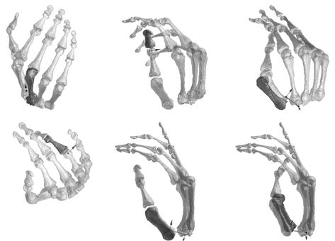 hand bones for homework Hand Bones Reference, Skeletal Hand Reference, Skeletal Hand Drawing, Finger Bones, Skeletal Hand, Hand Bones Drawing, Skeleton Hand Poses, Skeleton Hand Reference, Bone Hand