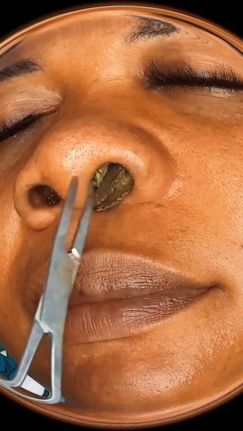 OMG! Hard Pimple, Pimples On Scalp, Satisfying Zit Popping Videos, Blackhead Remover Diy, Face Mapping Acne, Get Rid Of Pimples, Rid Of Pimples, Zit Popping Videos, Acne Treatments