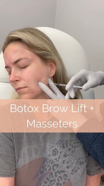 Masseter Botox Injection, Facial Anatomy For Injectors, Botox Masseter Before And After, Masseter Botox Before And After, Aesthetic Injector, Md Aesthetic, Face Plastic Surgery, Botox Brow Lift, Botox Before And After