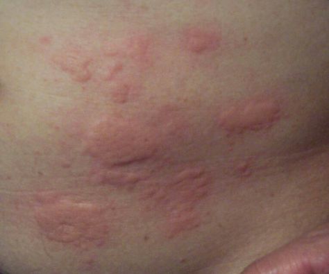 ..... Rash On Stomach, Armpit Rash, Facial Warts, Yeast Infection Causes, Chest Acne, Yeast Infection Symptoms, Heat Rash, Natural Acne, Home Remedies For Acne