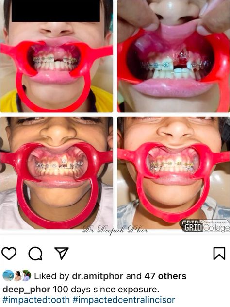 #braces #orthodontics #iimpacted Braces, Pins