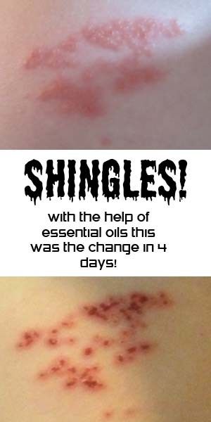 Shingles- Overcoming With The Help Of Essential Oils! Shingles Remedies, Essential Oils For Shingles, Treating Shingles, Shingles Relief, Doterra Onguard, Moving To College, Liver Rescue, Nerve Pain Remedies, Essential Oils For Pain