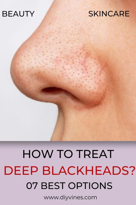 How To Treat Deep Blackheads? 07 Best Options Natural Black Head Remover, Getting Rid Of Blackheads On Nose, Blackheads On Face, Blackhead Remedies, Blackheads On Nose, Blackhead Mask, Black Heads, Home Remedy For Cough, Cold Sores Remedies