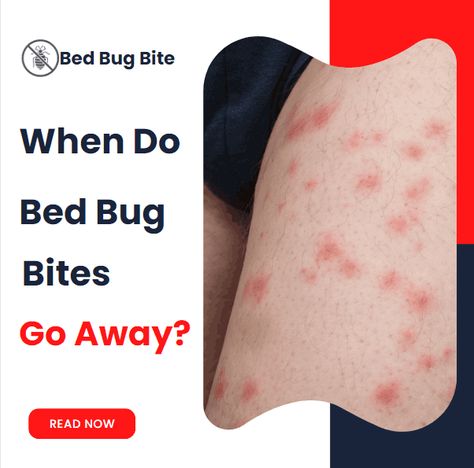 When Do Bed Bug Bites Go Away? - Bed Bug Bite Bed Bugs Bites, Bed Bug Bites Pictures, Bed Bugs Pictures, Signs Of Bed Bugs, Bug Bite Relief, Kill Bed Bugs, Bug Bite, Rid Of Bed Bugs, Bed Bug Bites